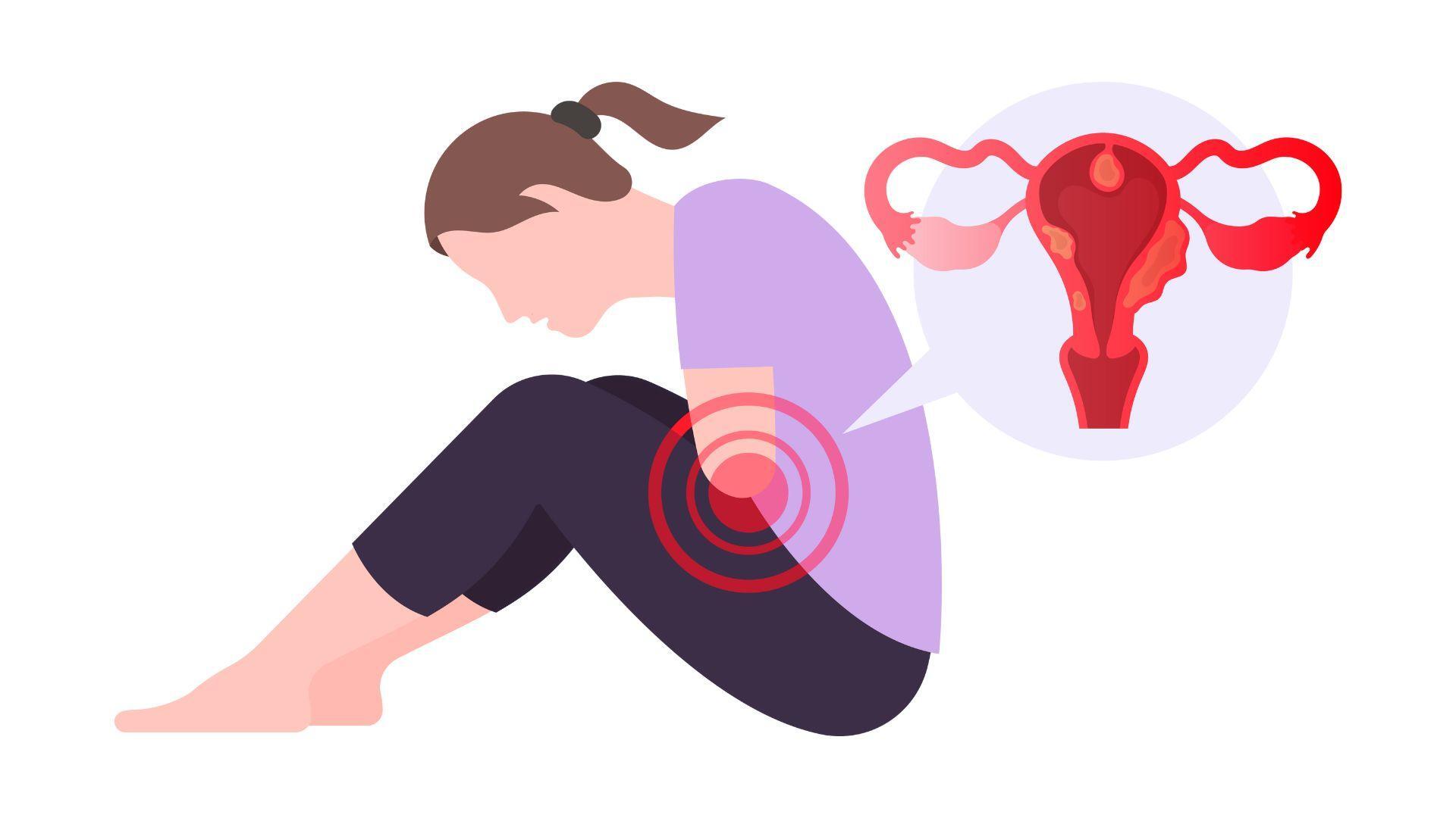 Endometriosis Treatment in Greater Noida West – Expert Care at Wonder Wombs